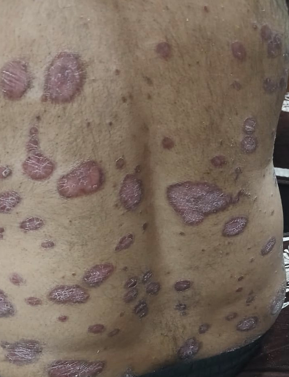 Skin & Psoriasis Care Treatment in Kharadi, Pune
